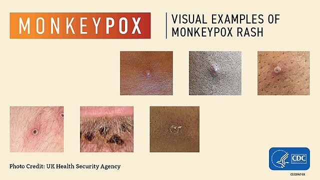 Mpox Appearance