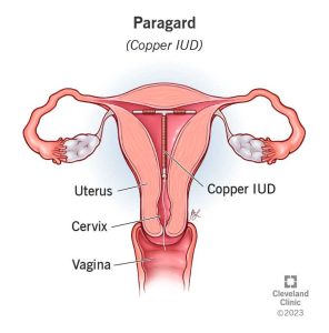 Intrauterine Device