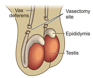 Vasectomy