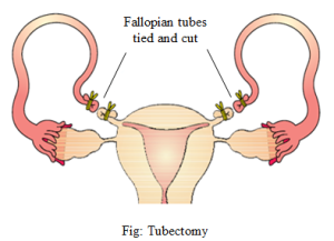 Tubectomy