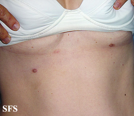 Supernumerary Nipples Along The Milk Line (Source: Wikidoc Library)