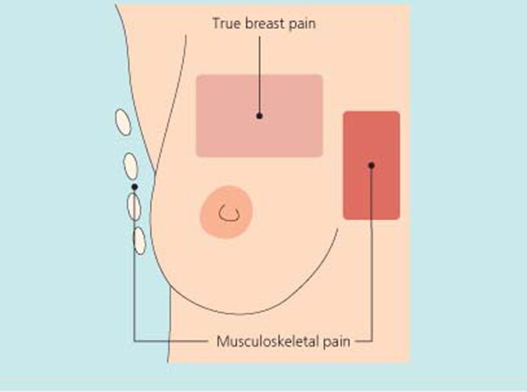 Mastalgia (Source: The British Medical Journal)