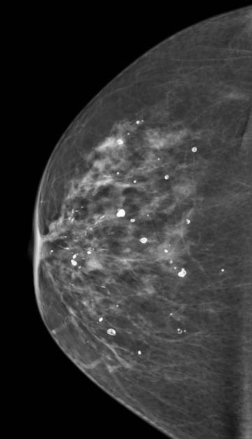 Microcalcifications in Breast (Source: Radiopedia)