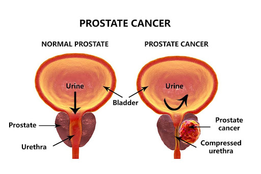 Graphic of normal prostate and one of prostate with cancer, leading to a compressed urethra.